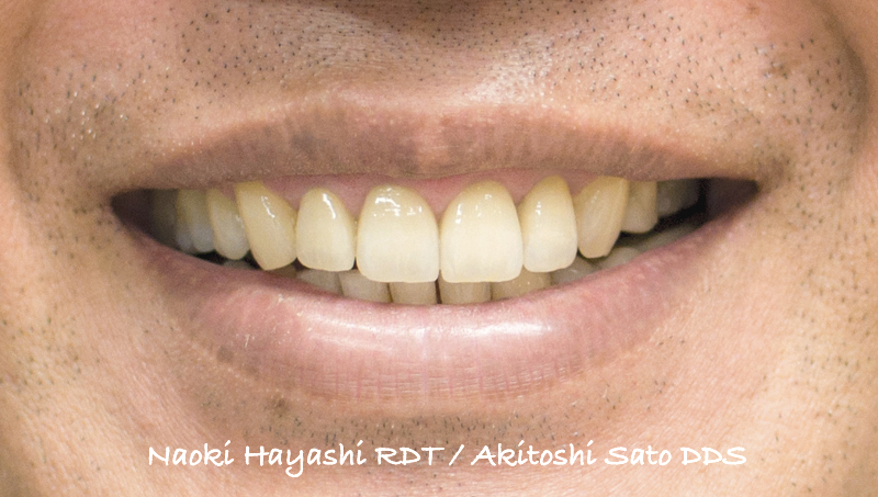 セラミック補綴物製作　 林 直樹　先生　（Ultimate Styles Dental Laboratory）