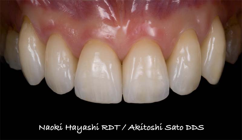 ラミネートベニア施術後の状態。歯の色調の改善と、ブラックトライアングルと呼ばれる歯と歯の黒い隙間をなくす処理も施されています。