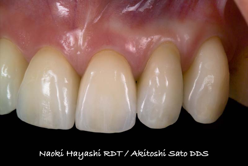 ラミネートベニア施術後の状態。歯の色調の改善と、ブラックトライアングルと呼ばれる歯と歯の黒い隙間をなくす処理も施されています。2