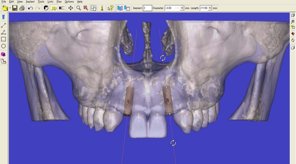 3次元CT画像解析/シュミレーションソフト、Nobel Clinician,およびSim/Plant の導入