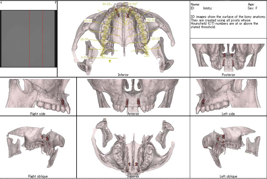 3次元CT画像解析/シュミレーションソフト、Nobel Clinician,およびSim/Plant の導入