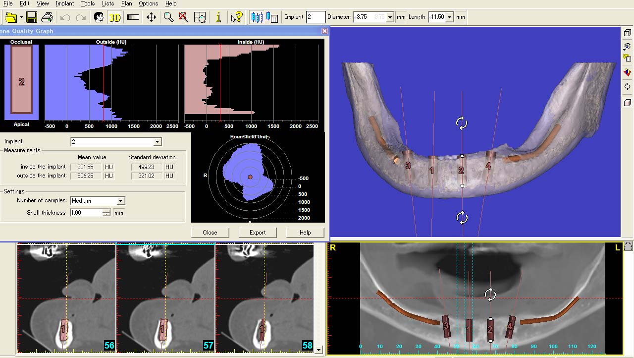 3次元CT画像解析/シュミレーションソフト、Nobel Clinician,およびSim/Plant の導入