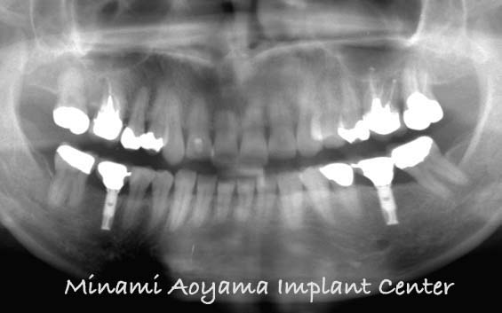 術後の口腔内の状態とレントゲン写真