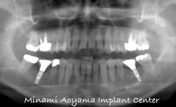 術後の口腔内の状態とレントゲン写真１。スクリューリテインニングのインプラント最終上部構造が装着されてています。
